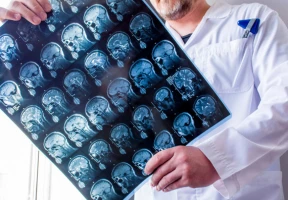 Diseases of the Nervous System